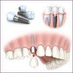 dentalimplants1