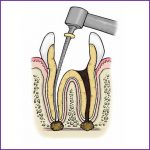 endodontic1