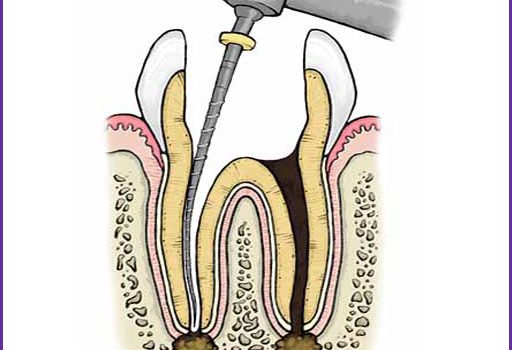 Endodontic Treatments